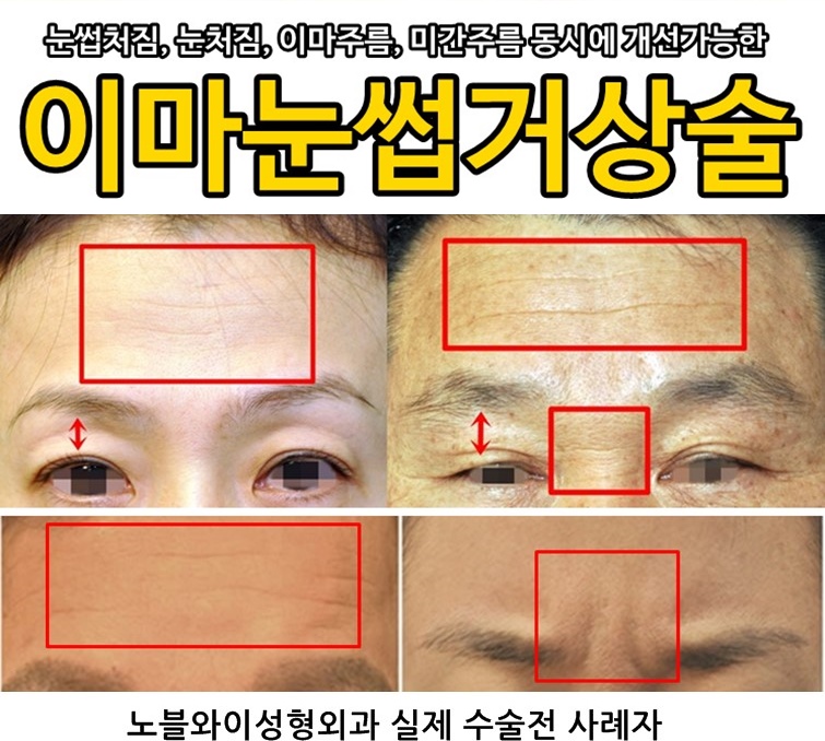  내시경이마거상술가격 하나에 이 모든 효과가