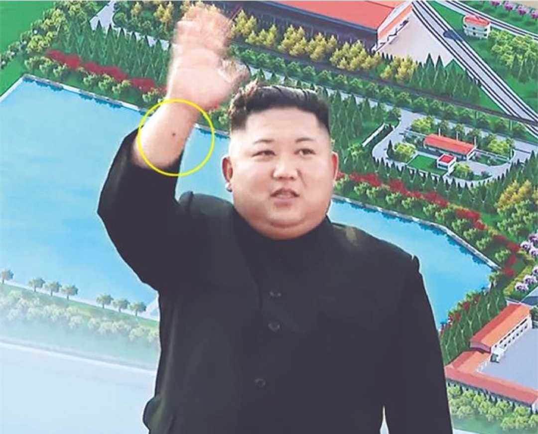  김정은 오른손목 점 심장 시술 흔적? 건강이상설 사실일까