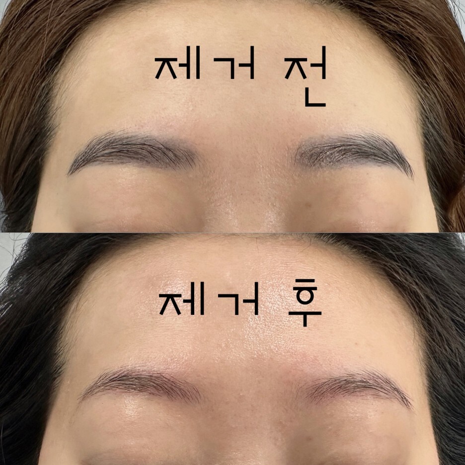  천안 눈썹문신 잔흔 제거!