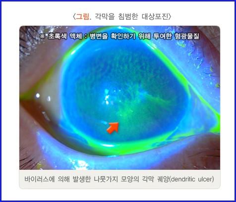 대상포진-각막