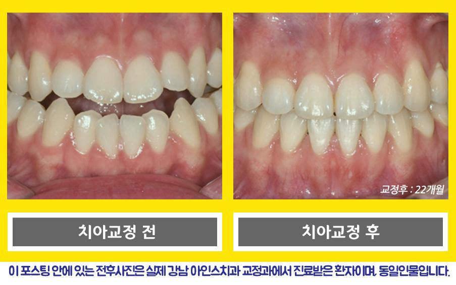 3급 부정교합 주걱턱 교정기간,