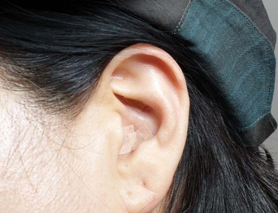 귀에 피내침을 놓은 후에 살색 테이프로 덧붙이는 이침을 놓은 후에 확대를 하여 찍은 사진