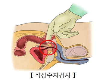 전립선 증상&#44;진단&#44;수술&#44;영양제&#44;예방