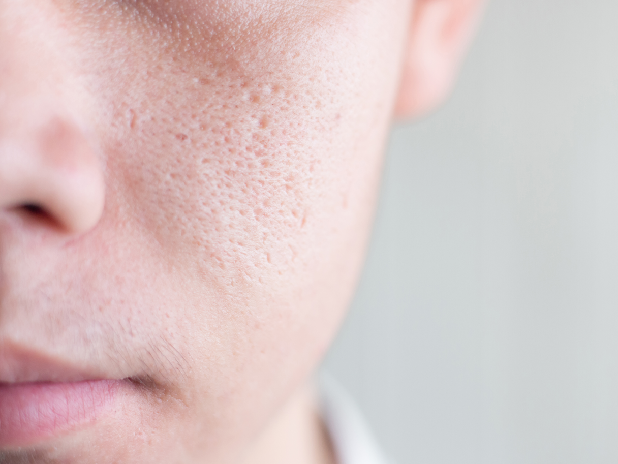 [공지] 모공을 줄이는 확실한 방법 - 옵셀로 모공 앰플