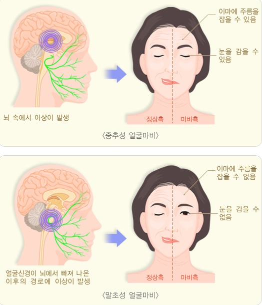 중추성 안면신경마비와 말초성 안면신경마비