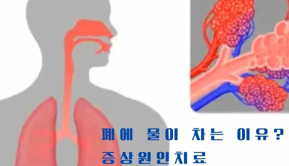 폐부종