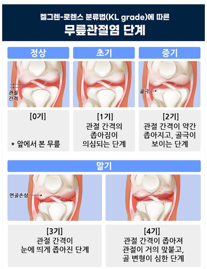 무릎관절염