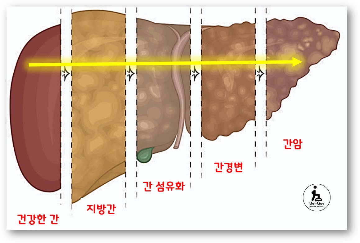 간질환의 진행