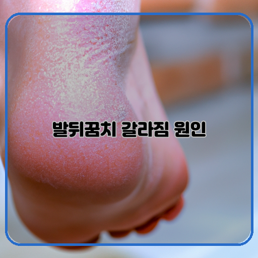 발뒤꿈치-갈라짐-발꿈치가-갈라지는-상황이나-증상-원인-발뒤꿈치-갈라짐이-발생하는-주요-원인-해결-방법-발뒤꿈치-갈라짐을-해결하기-위한-대처나-치료-방법
