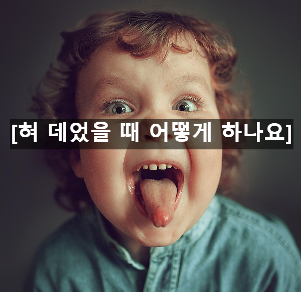  혀 데었을 때 어떻게 하나요 대처법