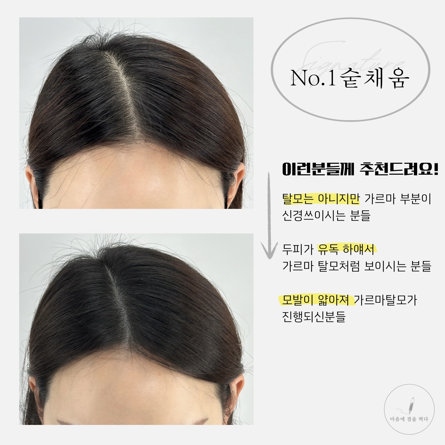 마음에점을찍다두피SMP 이미지
