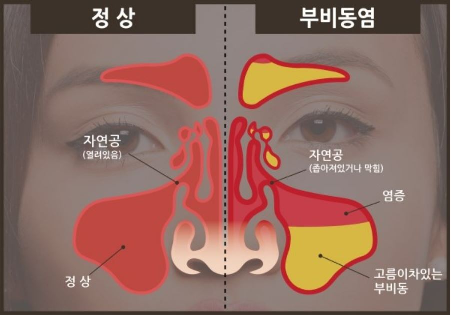 축농증&#44;부비동염