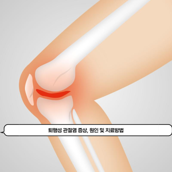  관절 주위에 염증이나 통증이 생긴다면 퇴행성 관절염을 의심해보셔야 할 때! 퇴행성 관절염의 증상, 원인 및 치료방법