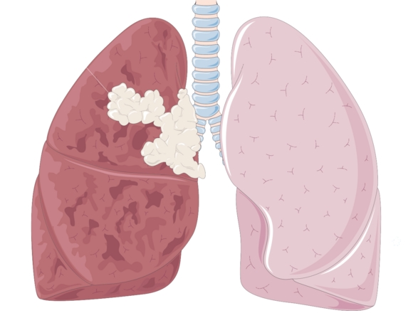 폐암