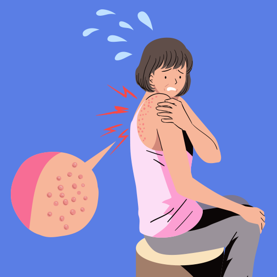  대상포진 초기증상 / 대상포진 치료방법