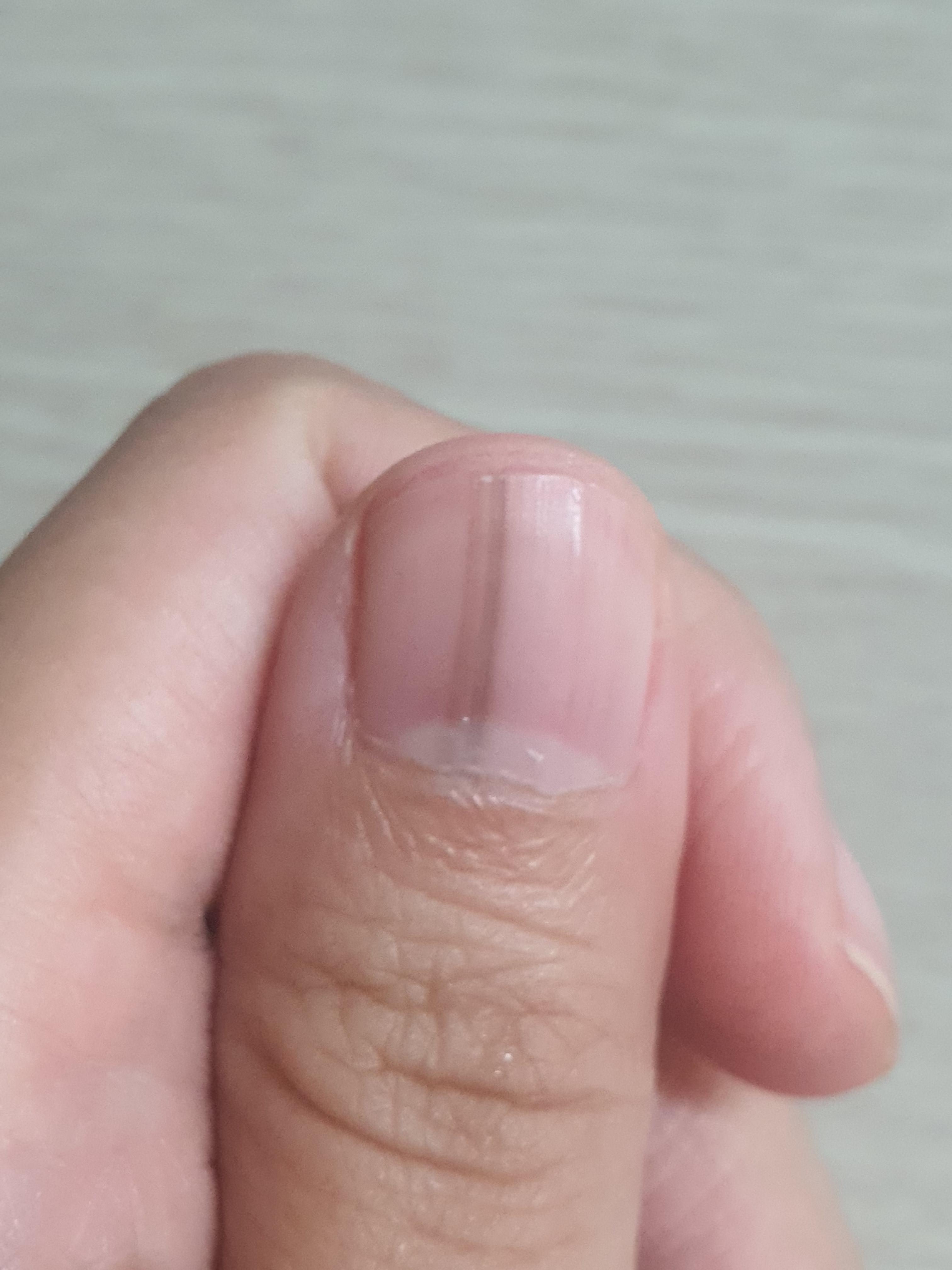  엄지손톱 검은색 세로줄이 4년 전부터 생겼다...