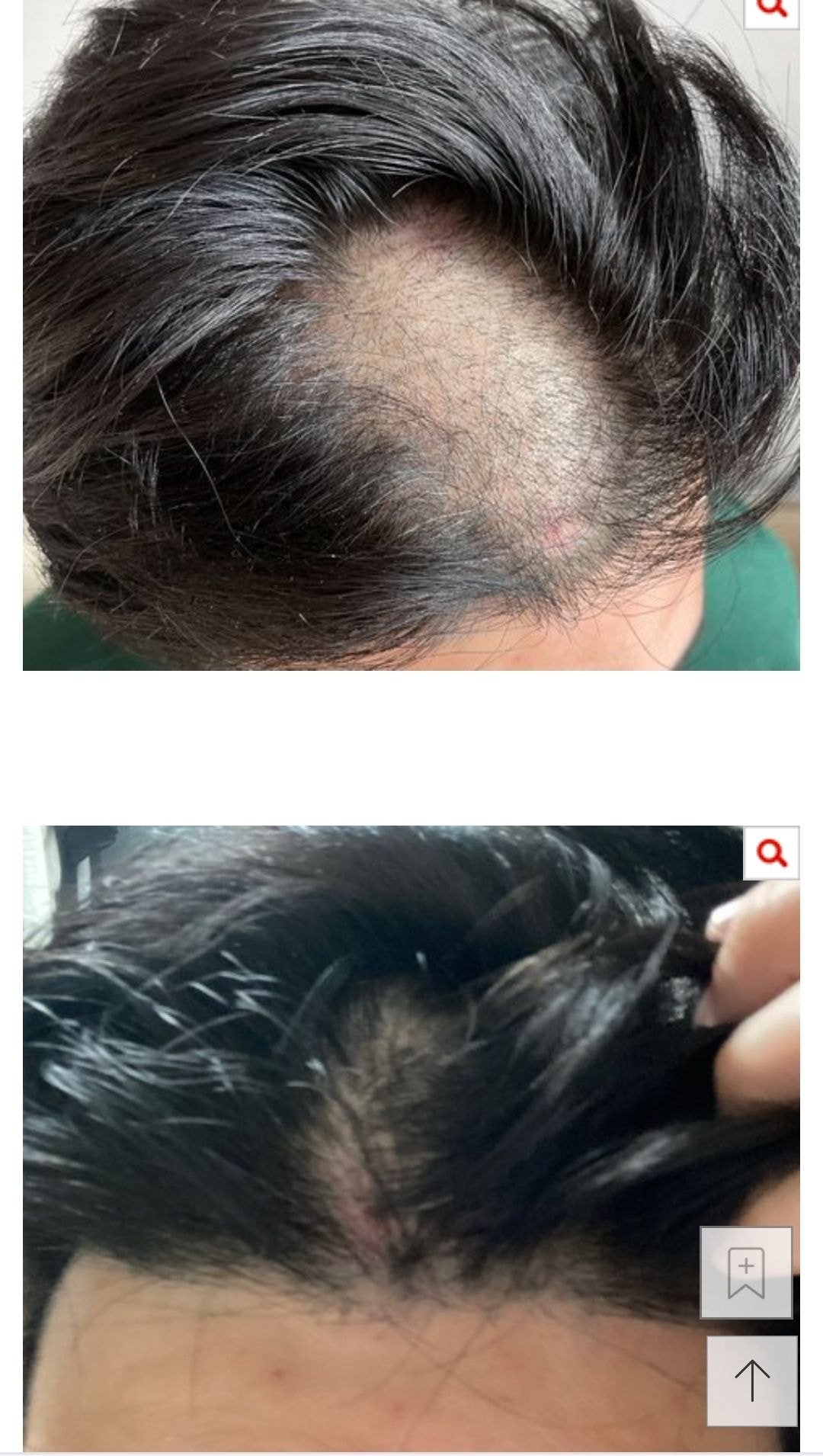 네이트판)셀프 매직 후 부작용으로 탈모 대머리가 됬습니다 사진有