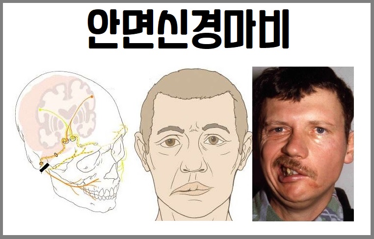 안면신경마비