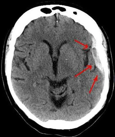 의학용어 ICH 뜻 Intracerebral hemorrhage 경막외출혈 경막밑출혈 거미막밑출혈 뇌내출혈 치료법