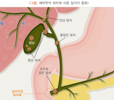 담석부위