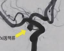 뇌동맥류 초기 증상