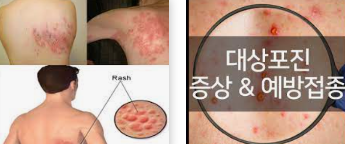 대상포진 증상(초기) 및 원인과 2