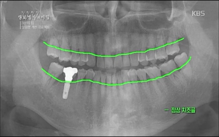 [670회] 생로병사의 비밀 - KBS670회] 생로병사의 비밀.ts_20220505_143155.402.jpg