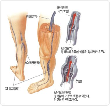 하지 정맥류 증상&amp;#44; 원인