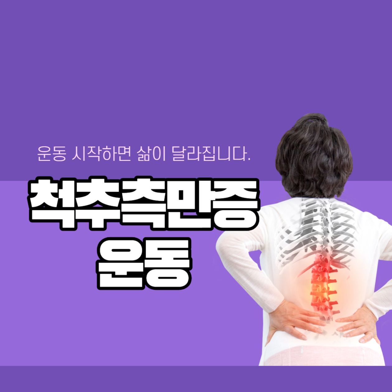  척추측만증 운동: 자세 개선과 강화를 위한 종합 가이드
