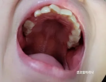 어금니 칫솔 사용법 선택방법 실사용 후기_14