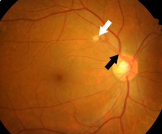  고혈압망막병증 원인,  증상, 치료 및 예방법 알아보기