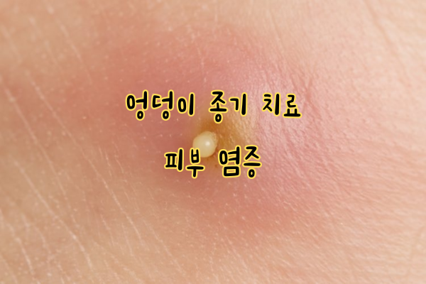 엉덩이 종기 치료 피부 염증