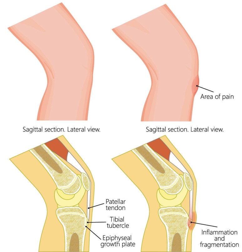 성장통 / 오스굿-슐라터병(Osgood-Schlatter disease) 양산 통증클리닉 - 6