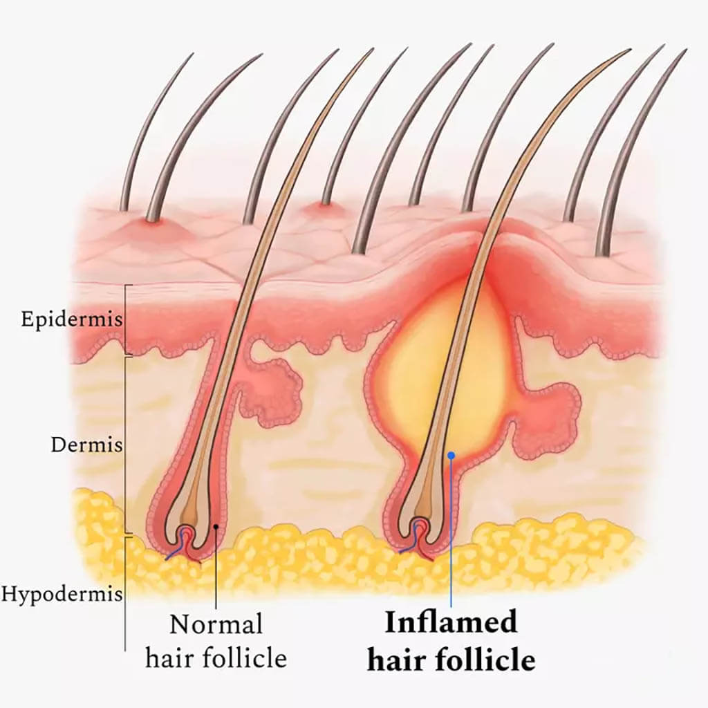때때로 모낭염은 여드름처럼 보이지만&#44; 모낭염은 더 크고 더 많은 융기와 함께 갑자기 발생하는 경향이 있다.