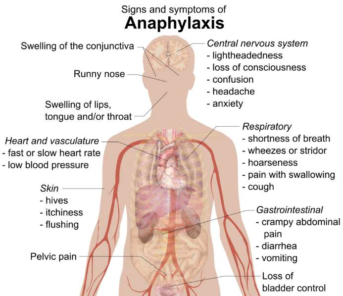 아나필락시스란 무엇인가요?