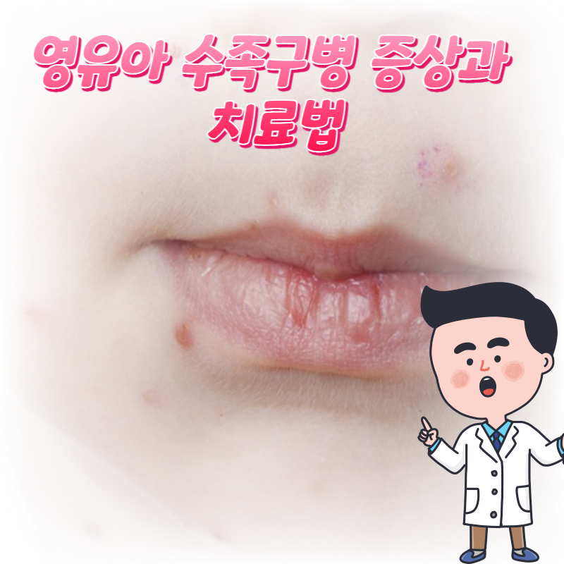  영유아 수족구병 증상과 치료법 예방방법 궁금증