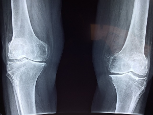 양족 무릎뼈의 엑스레이를 촬영한 사진