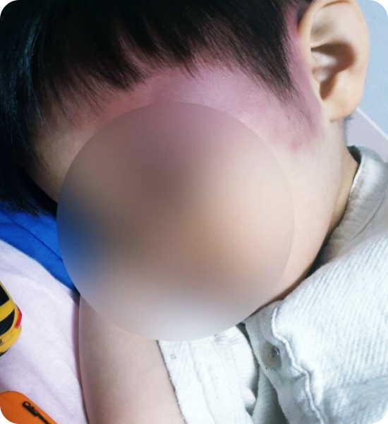  4살 아동 두 눈에 피멍 들 때까지 때린 40대...피해 아동 엄마의 남자친구가 폭행