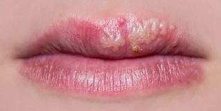 입술 헤르페스 증상, 원인 및 치료