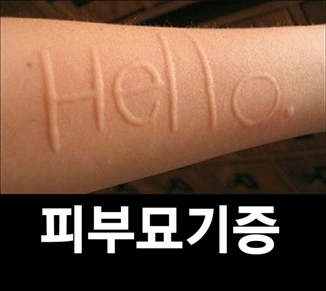  피부묘기증, 피부가 부풀어 오르는 피부 묘기증의 원인과 피부묘기증 증상, 치료
