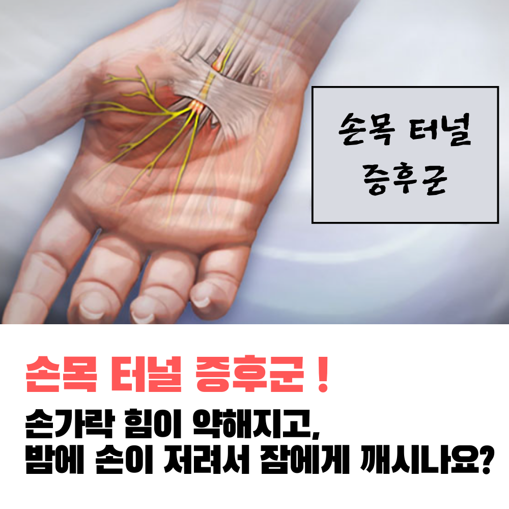 손목-터널-증후군
