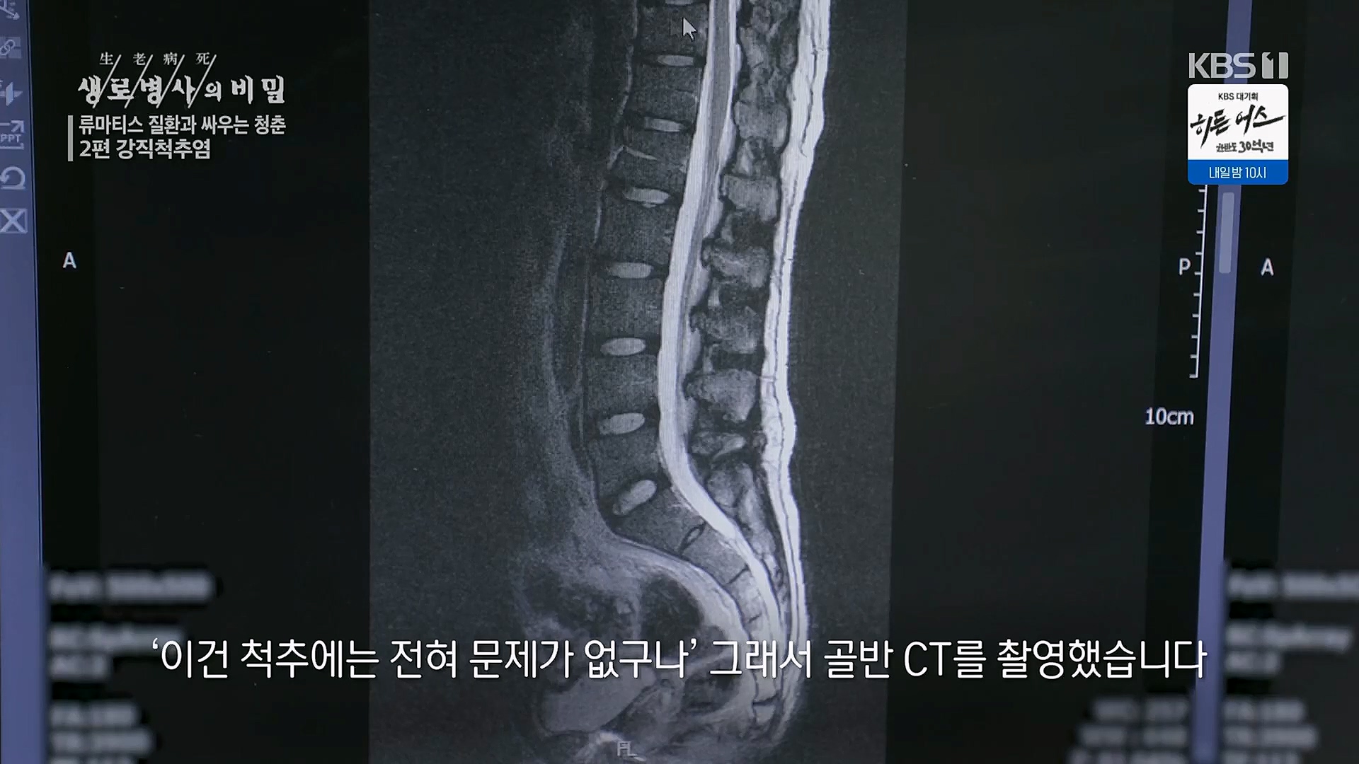 생로병사의 비밀.E861.230322p.H264-F1RST.mp4_20230323_204404.728.jpg