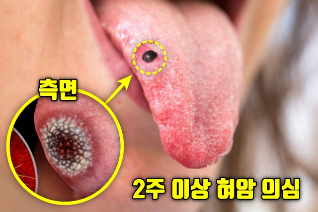 혀에 혹 혀암 초기증상 혀 이상증세 돌연사 전조증상