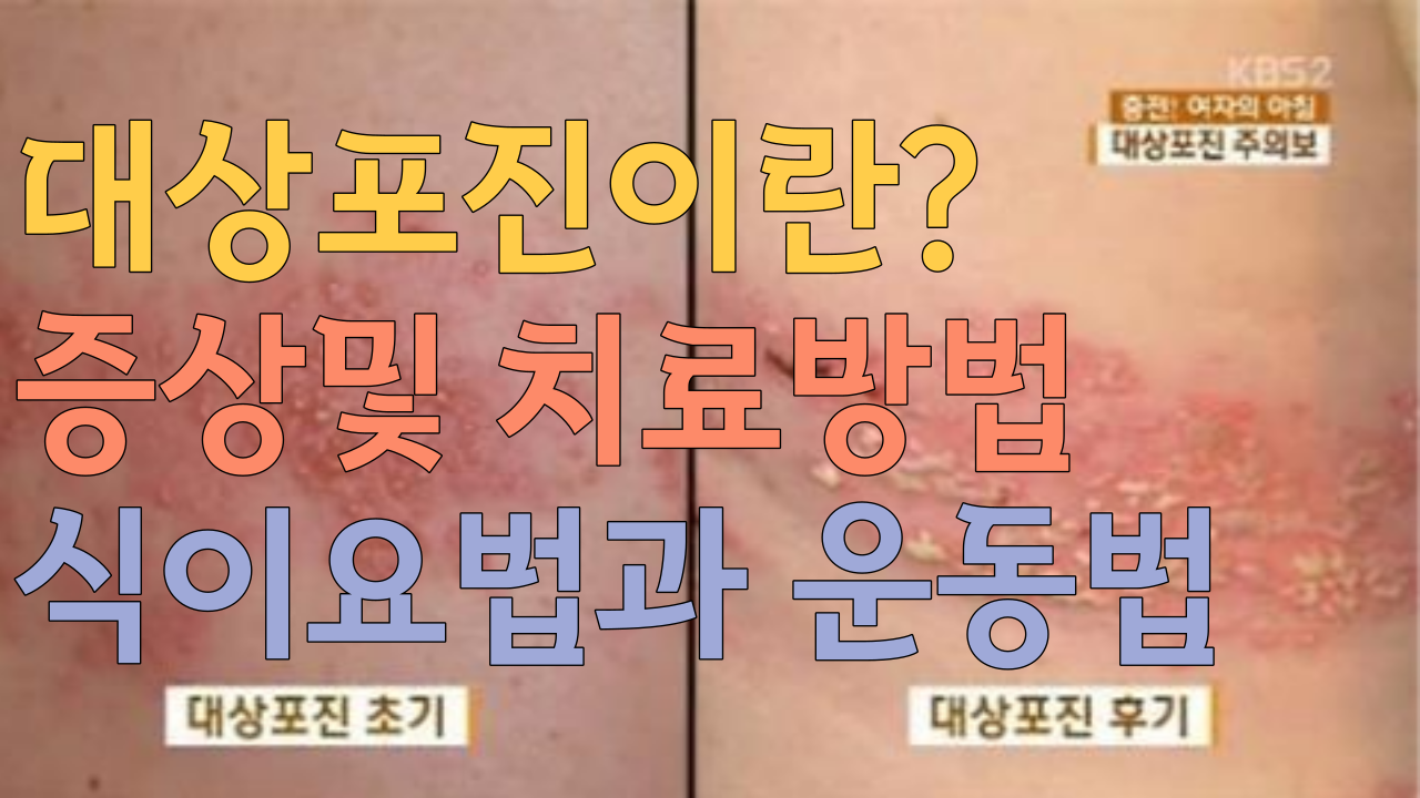  대상포진이란? 증상및 치료방법 식이요법과 운동법
