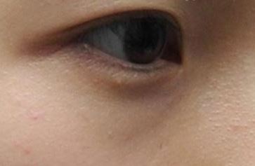  다크서클 색 종류별 원인 예방 치료법.. 눈 너무 세게 비비지 마세요
