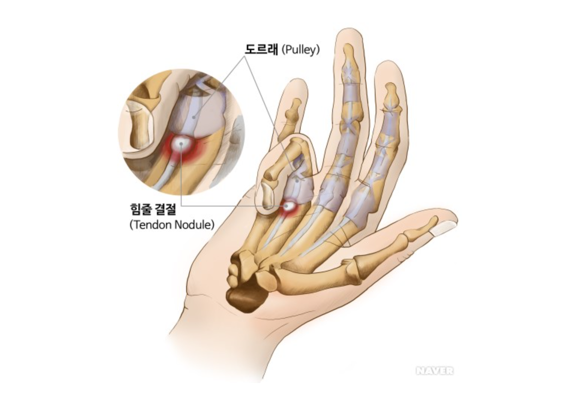  손가락통증 : 방아쇠수지?  척골신경압박증후군(팔꿈치터널증후군)? 증상 및 치료 정확히 짚고 넘어가세요