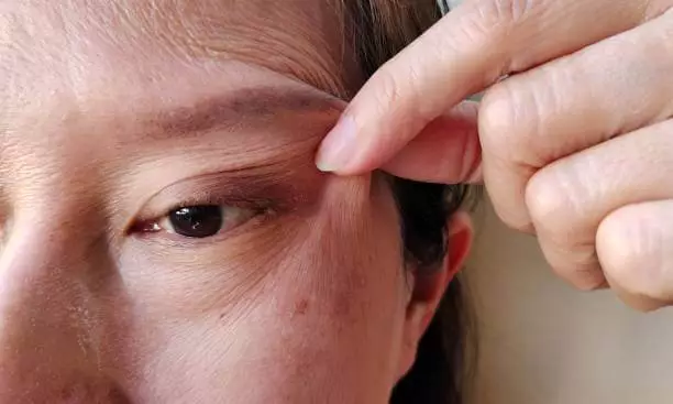 쌍꺼풀 수술비용 재수술