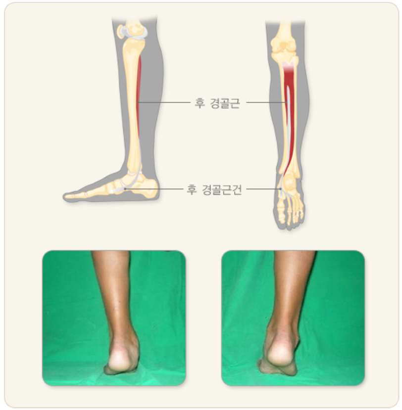 후 경골근건 기능 평가