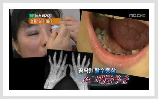 쇼그렌 증후군에 대하여 4