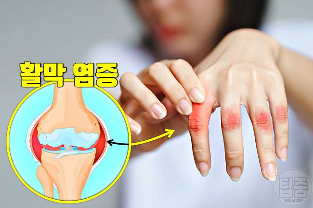 류마티스 관절염 초기 증상 자가진단